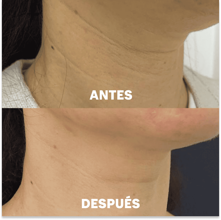 Mascarillas para el Cuello Aurealface™